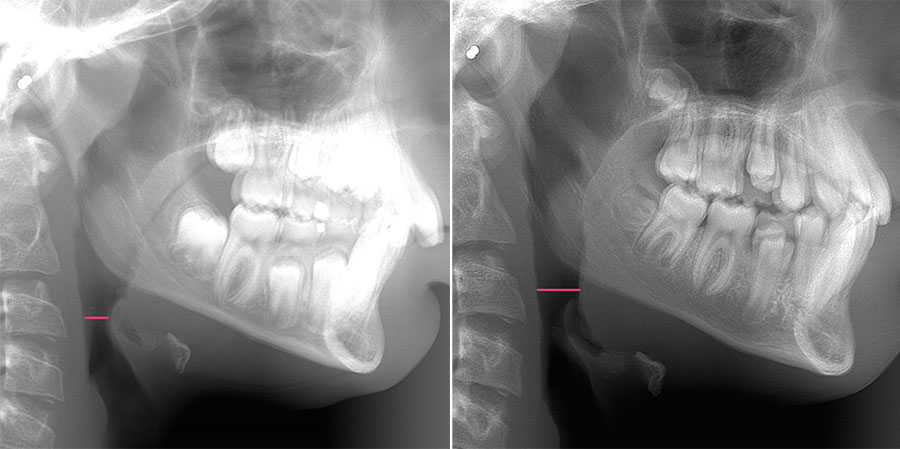 orthodontist Turnhout De Zutter