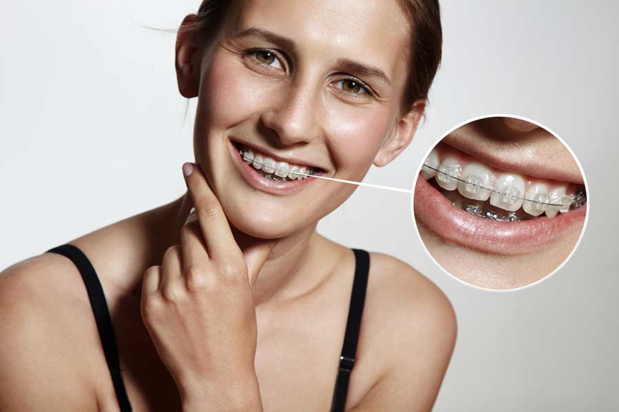 orthodontistie volwassenen Turnhout De Zutter